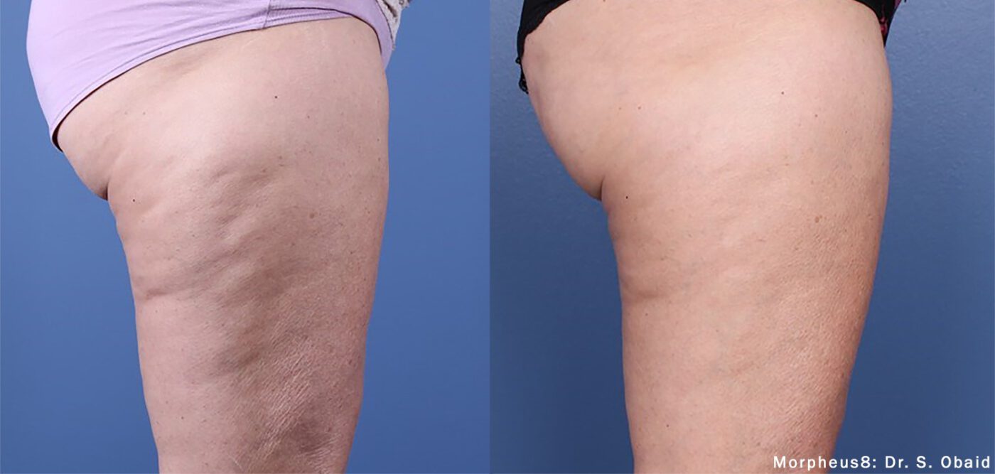 before-and-after-legs-and-buttocks