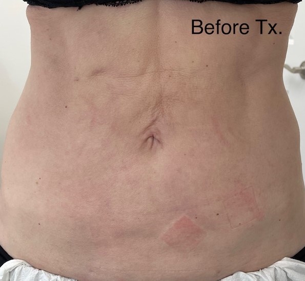belly-before-skin-treatment