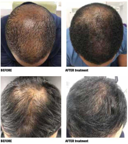 before-and-after-male-balding